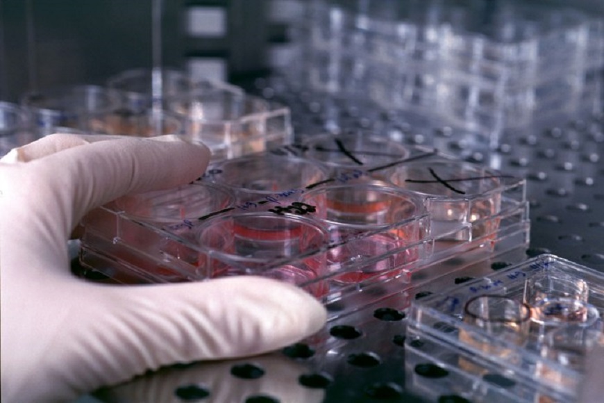 La sclerosi multipla migliora con il trattamento contro il cancro