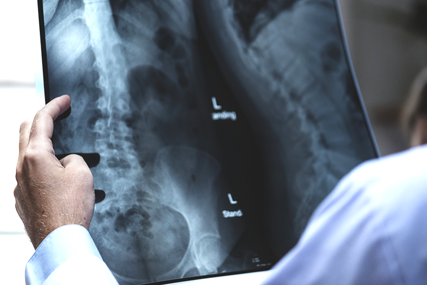 Vite spezzate l’osteoporosi colpisce 4 milioni di italiani